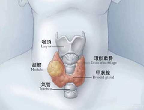 怎样防治甲状腺肿大？